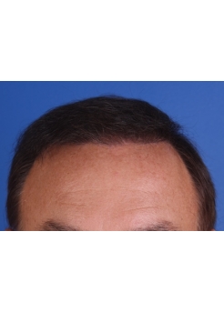 After Hair Transplant&nbsp;Front
